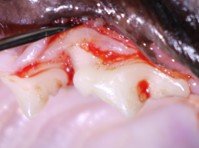 Open gums (surgical view)